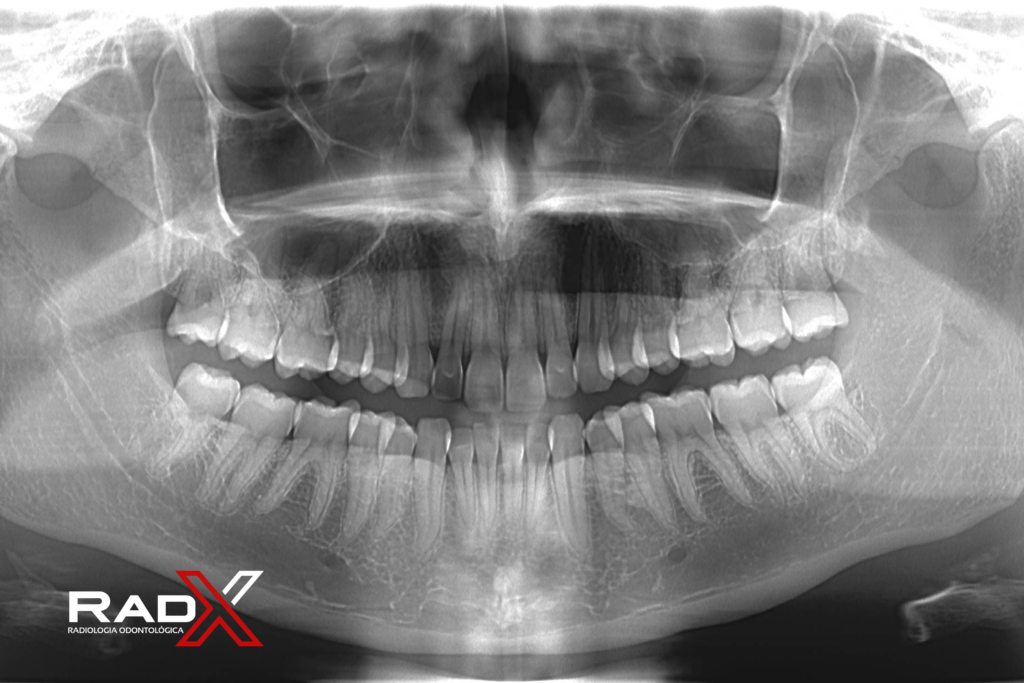 Radiografia Panorâmica