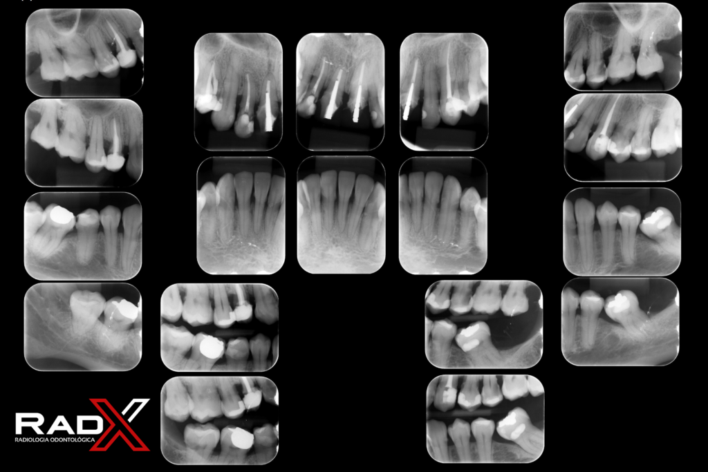 Radiografia Periapical Completo