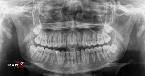 Raio x dente radiografia odontologica dentista raio x radiografia dental raio x dentista