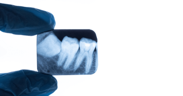 periapical dentária