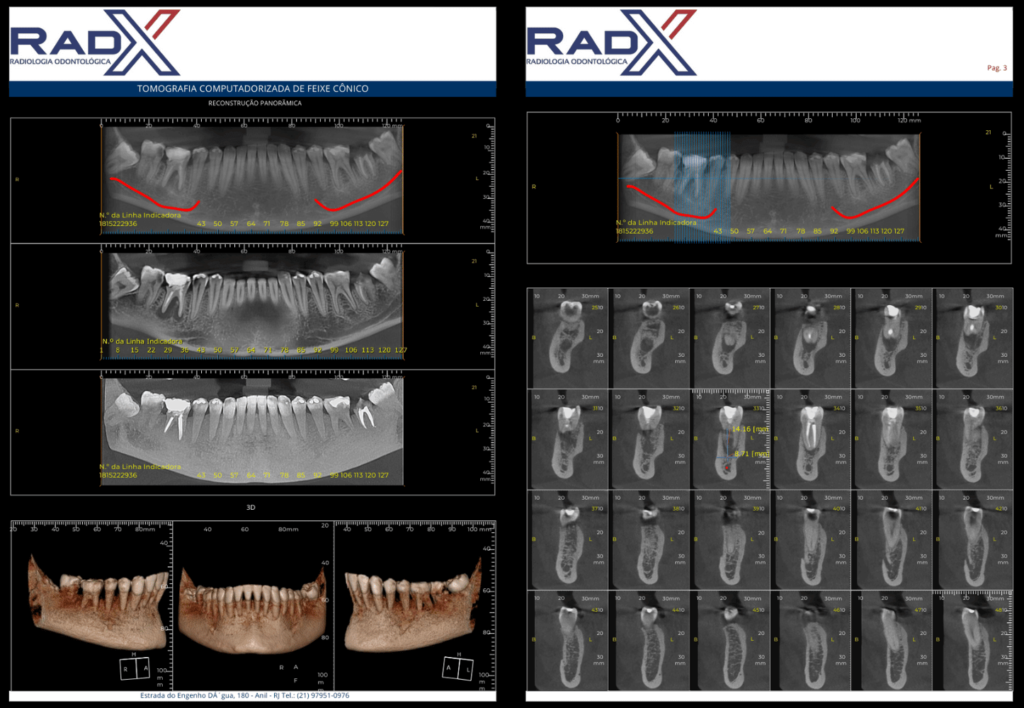 Tomografia Cone Beam nas especialidades odontológicas: ortodontia, periodontia, implante dentário implantodontia, clínica geral