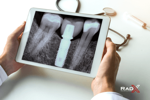Radiografia Periapical Completa