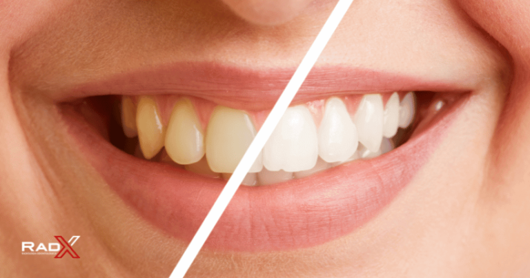 Clareamento dental Clareamento dentario Clareamento dentes
