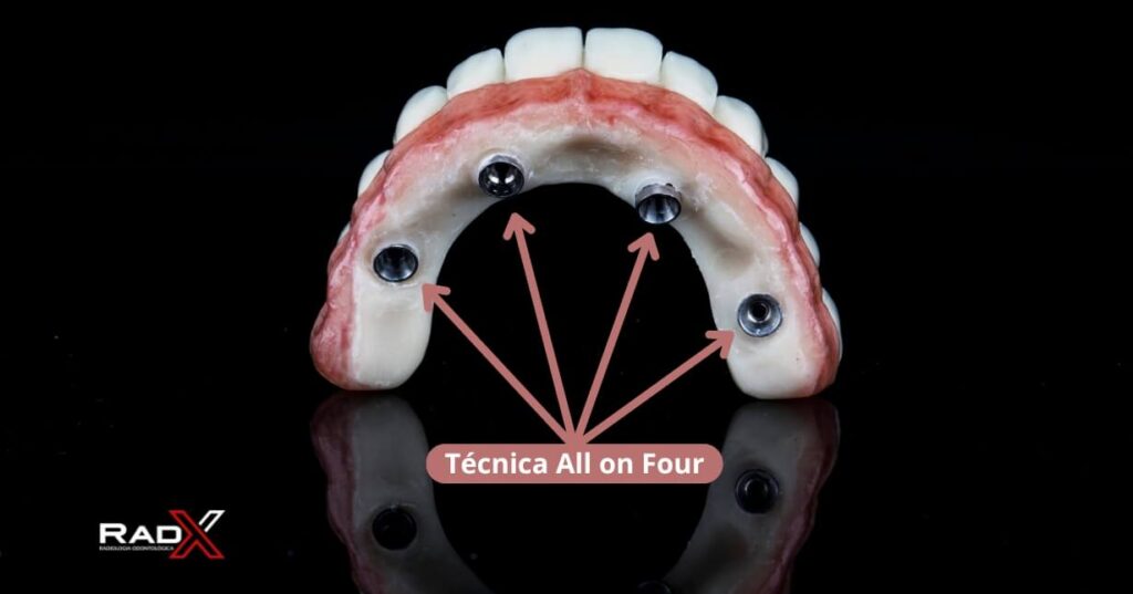 all four all on four all on 4 tecnica all on four técnica all on four tecnica all on 4 all on four superior all on four inferior