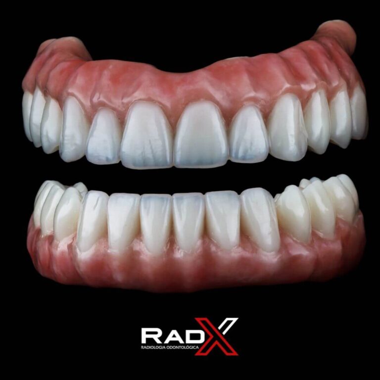 protese protocolo prótese overdenture