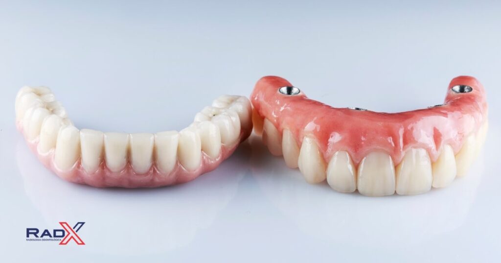 prótese protocolo superior protocolo superior protese protocolo superior protocolo inferior protese protocolo inferior protocolo dentario inferior overdenture superior overdenture inferior protese overdenture inferior protese overdenture superior