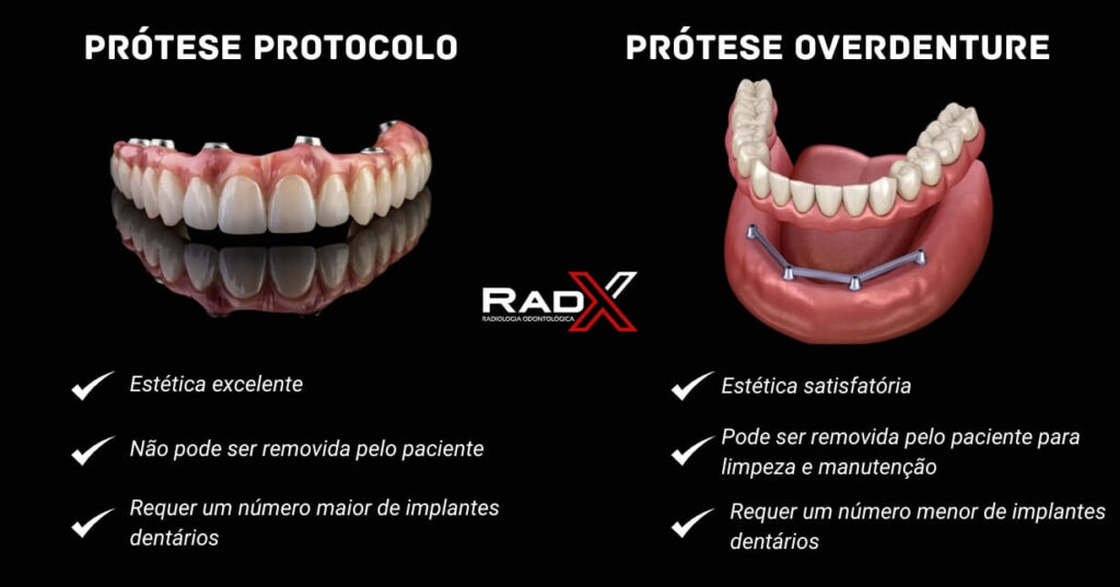 protese protocolo ou protese overdenture qual a melhor? overdenture implante protocolo