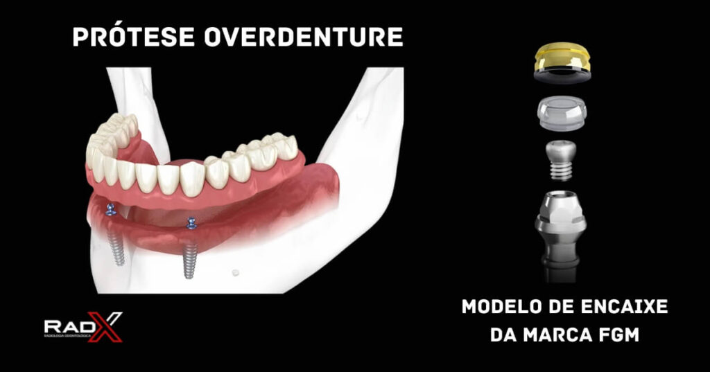 prótese overdenture protese overdenture overdenture overdenture de encaixe overdenture sobre implante protese removivel de encaixe